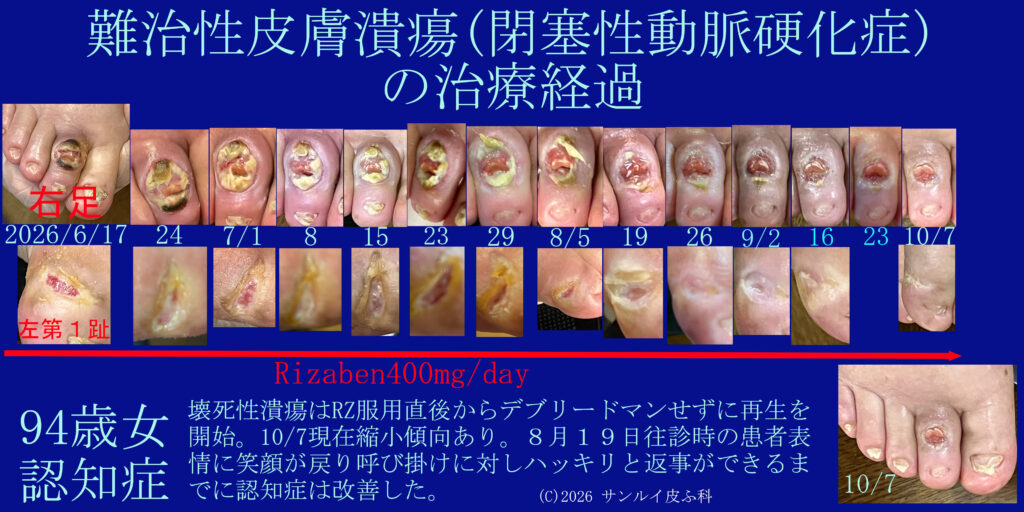 閉塞性動脈硬化症による皮膚潰瘍