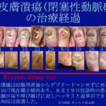 閉塞性動脈硬化症による皮膚潰瘍