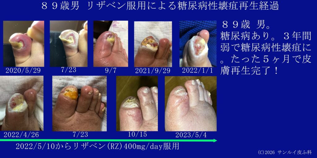 糖尿病性壊疽