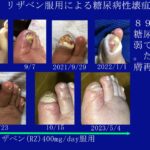 糖尿病性壊疽